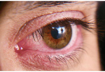 FDA approves generic version of dry eye treatment