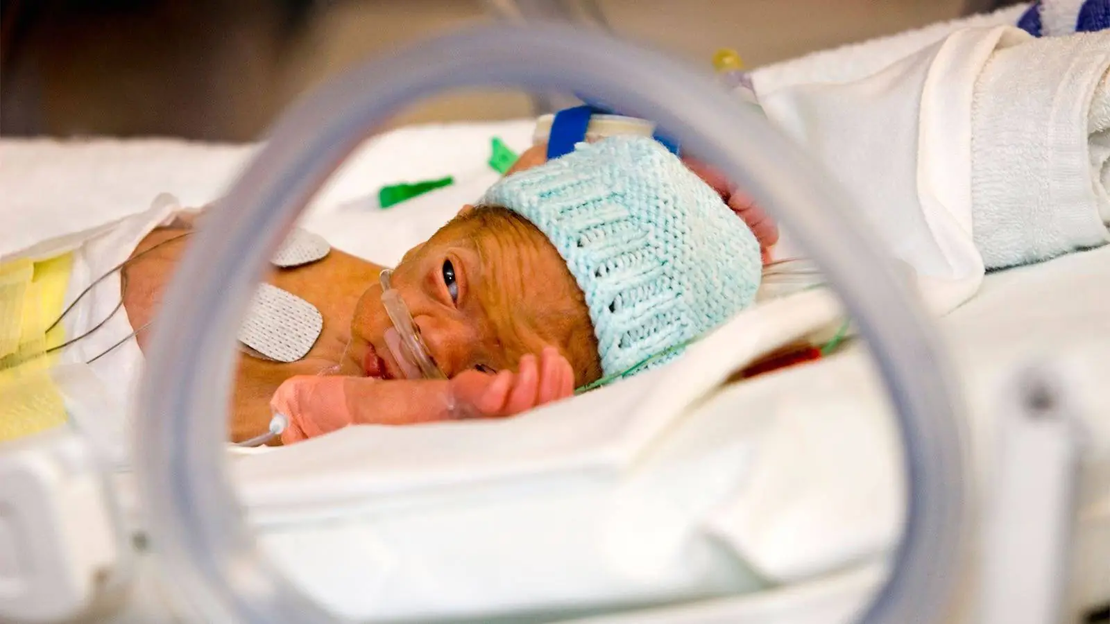 Extremely Preterm Babies Have Higher Risk of Eye Problems as Adults
