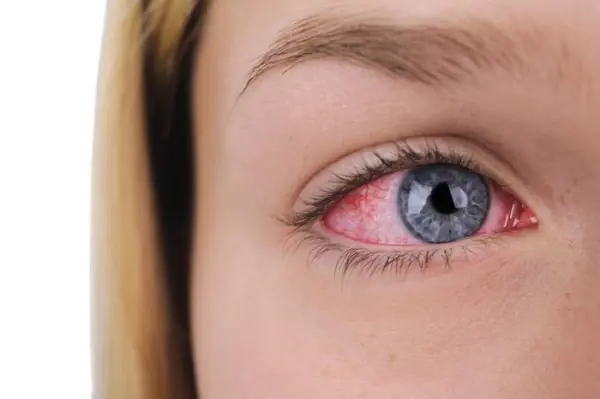 Dry Eye Problem